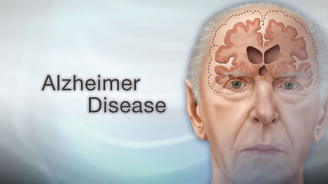 بهترین مکمل های غذایی برای بیماری آلزایمر با بهترین دکتر آلزایمر در کرج