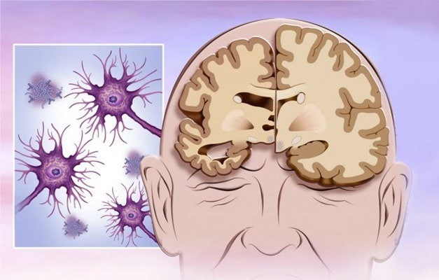بررسی بیماری آلزایمر و علائم آن با دکتر فوق تخصص فراموشی و آلزایمر