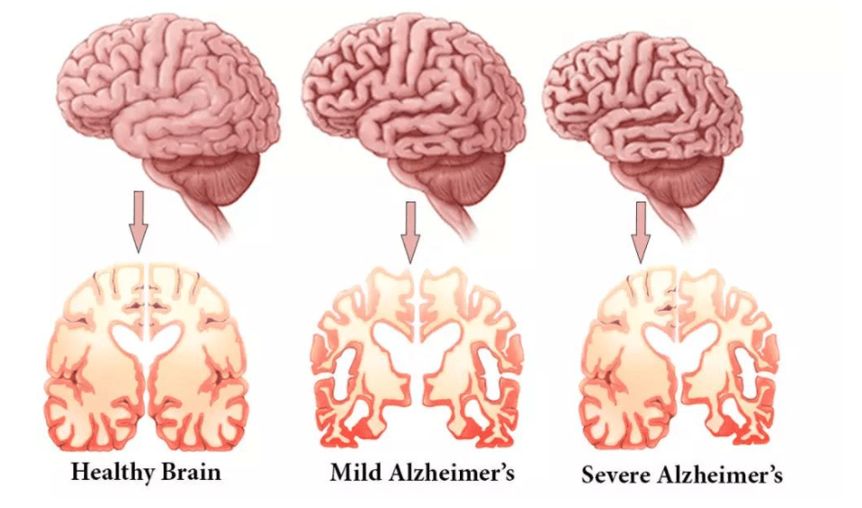 بررسی مراحل آلزایمر با با دکتر خوب برای الزایمر نی نی سایت