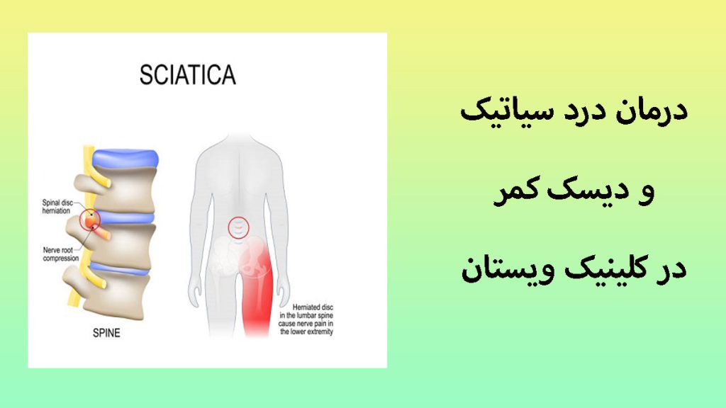 درد سیاتیک پس زمینه ای سبز- یک تصویر از رگ سیاتیک