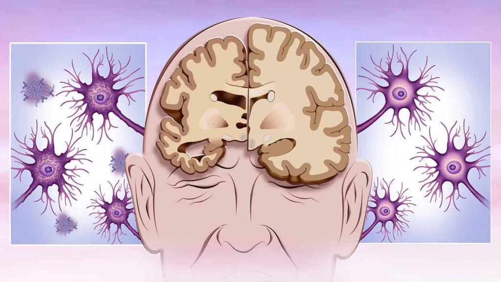 علائم اولیه بیماری آلزایمر و بهترین دکتر آلزایمر در تهران نی نی سایت