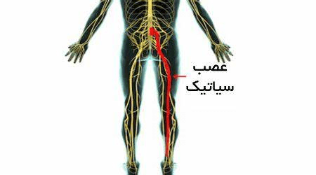 علائم سیاتیک چیست و چه چیزی باعث درد عصب سیاتیک می شود؟