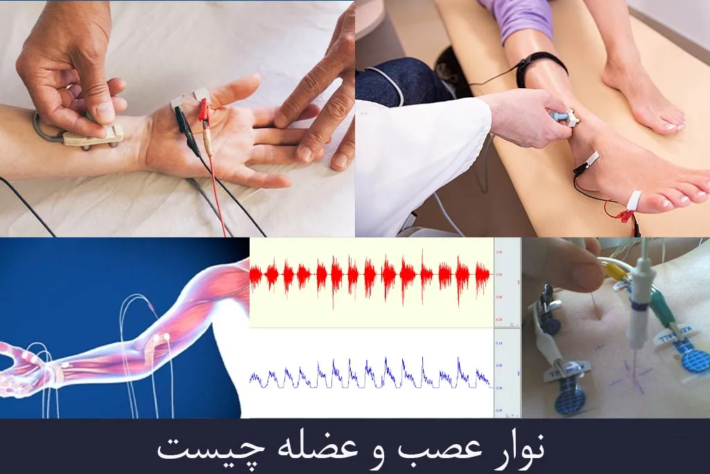 انواع سنسور EMG یا نوار عصب و عضله چیست؟