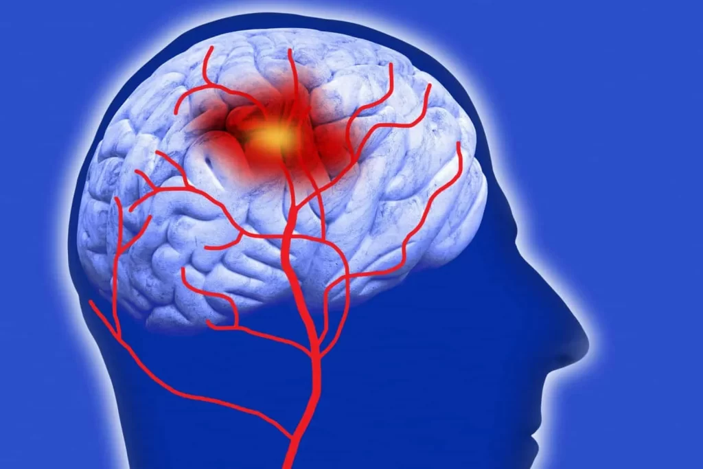 نوار مغز نرمال و نوار مغز (EEG) چیست؟