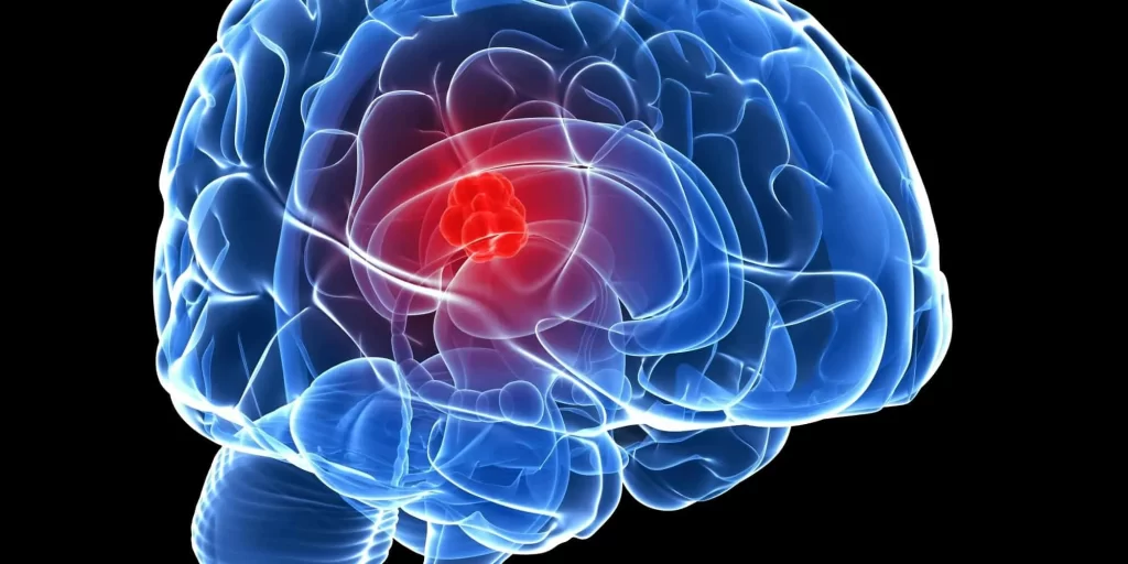 بررسی ویژگی سردردهای تومور مغزی با متخصص مغز و اعصاب تهران