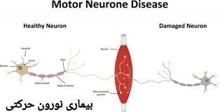 بیماری نورون حرکتی
