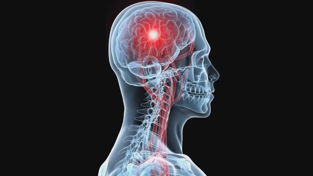 فیزیوتراپی پس از سکته مغزی و انواع سکته مغزی