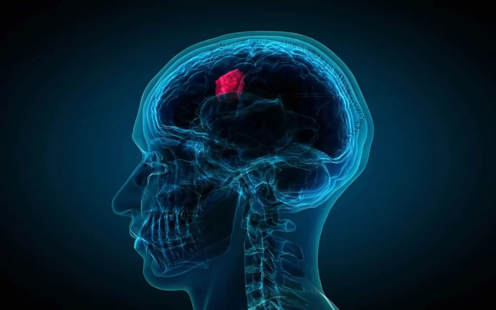 بررسی علائم تومور مغزی در جوانان