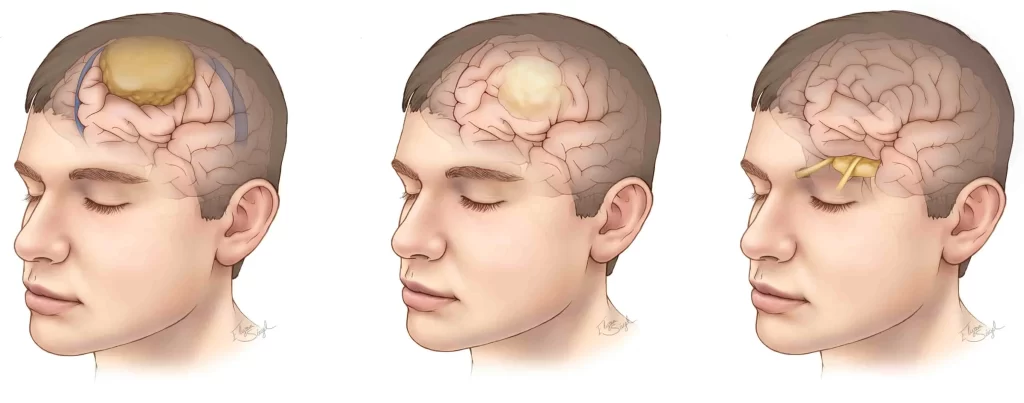 علائم تومور مغزی در زنان چگونه است؟