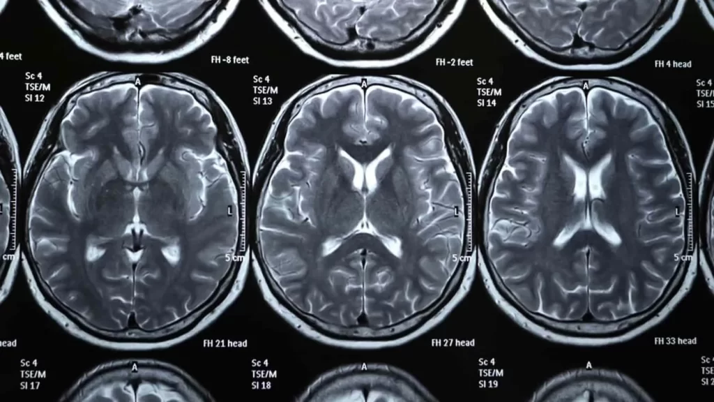 ویژگی‌ سردردهای تومور مغزی: علائم سردرد ناشی از تومور مغزی