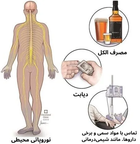 پلی نوروپاتی