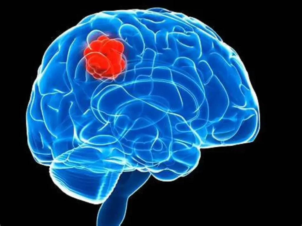 تشخیص و درمان بیماری‌ مغز و اعصاب نورولوژی با متخصص مغز و اعصاب