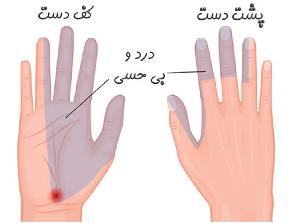 علائم سندرم تونل کارپال در بارداری چیست؟ علائم سندرم تونل کارپال در بارداری چیست؟