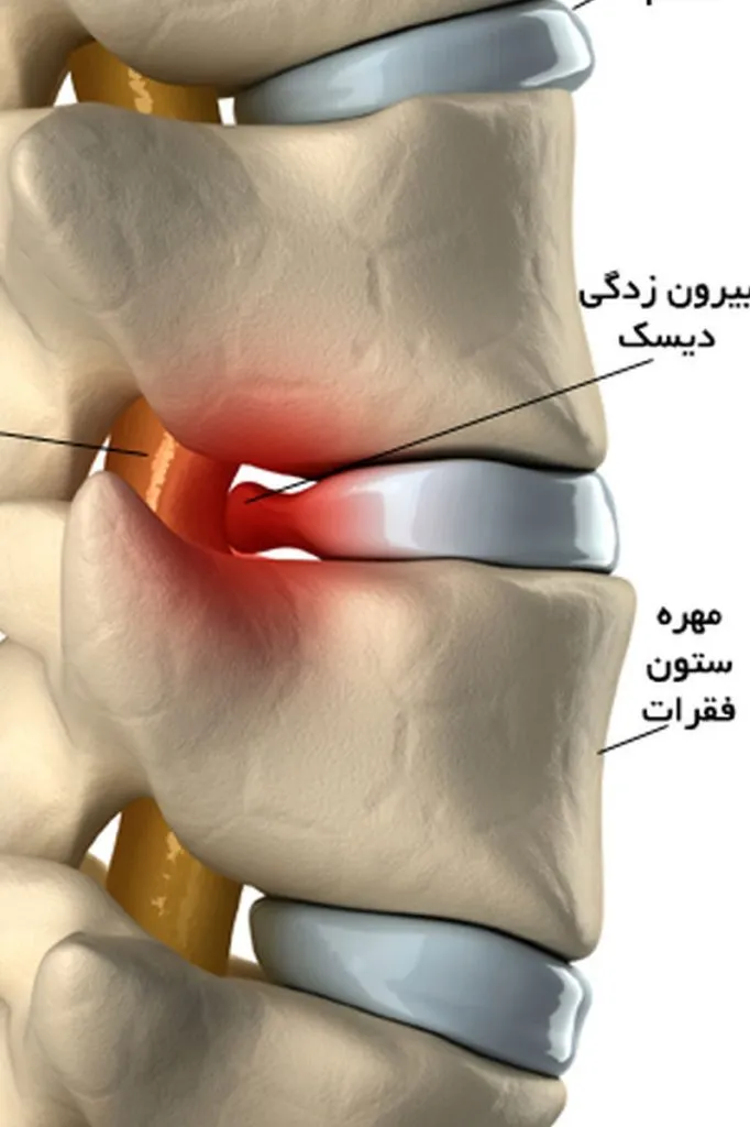 نحوه تشخیص فتق دیسک کمر با نوار عصب و عضله دیسک کمر 
