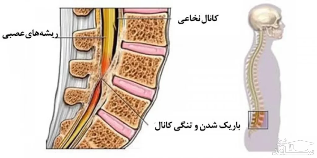 تنگی کانال نخاعی کمری ( Lumbar Spinal Stenosis ) در انجام تست عصب سیاتیک