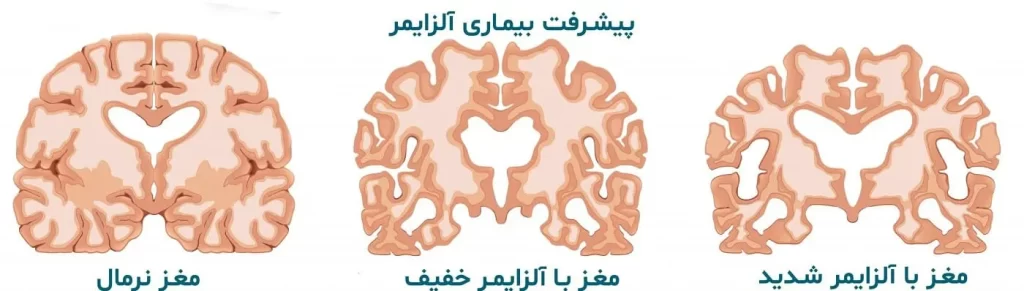 متخصص الزایمر