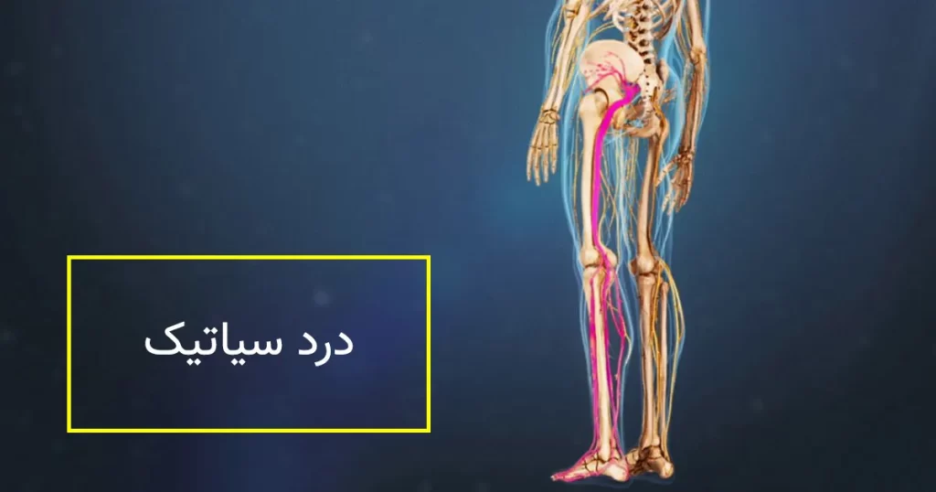 نوار عصب و عضله سیاتیک چیست؟