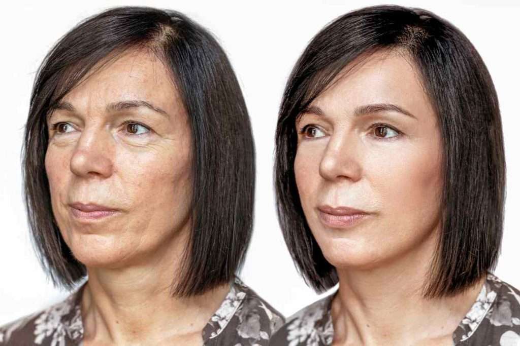 قبل و بعد از تزریق پی ار پی صورت