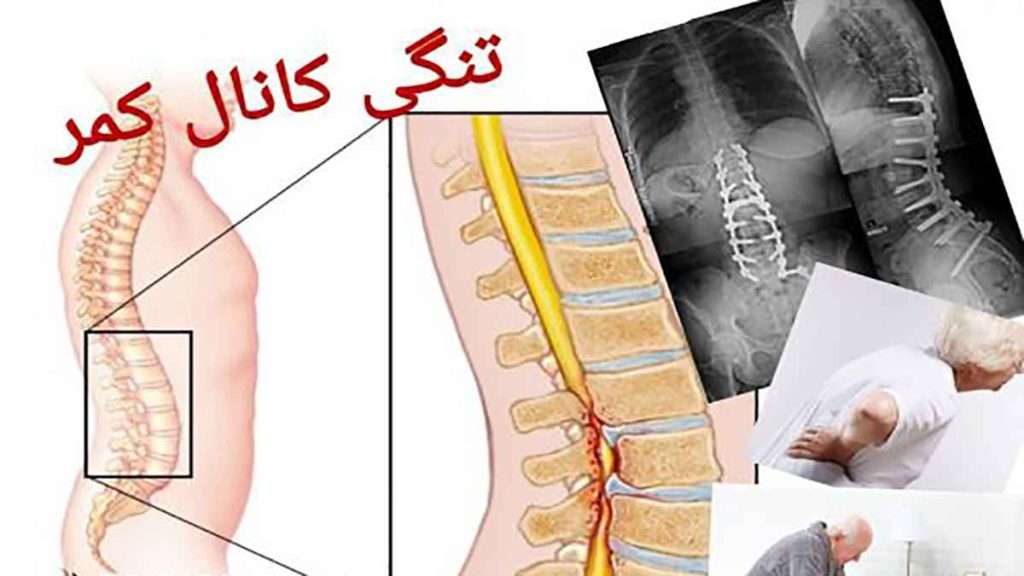 تفاوت آرتروز و تنگی کانال نخاعی