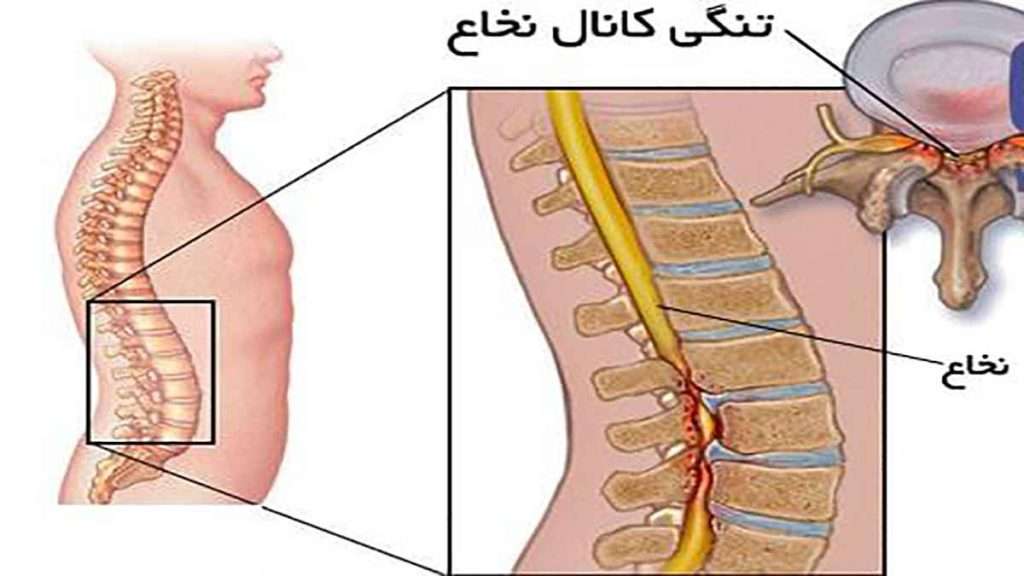 علائم تنگی کانال نخاعی