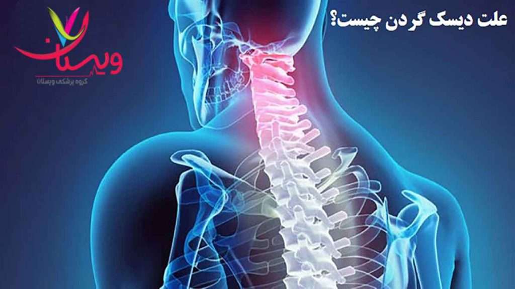 علت دیسک گردن