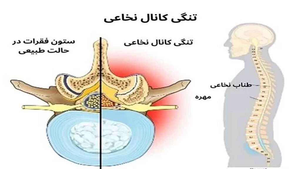 تنگی کانال نخاعی چیست
