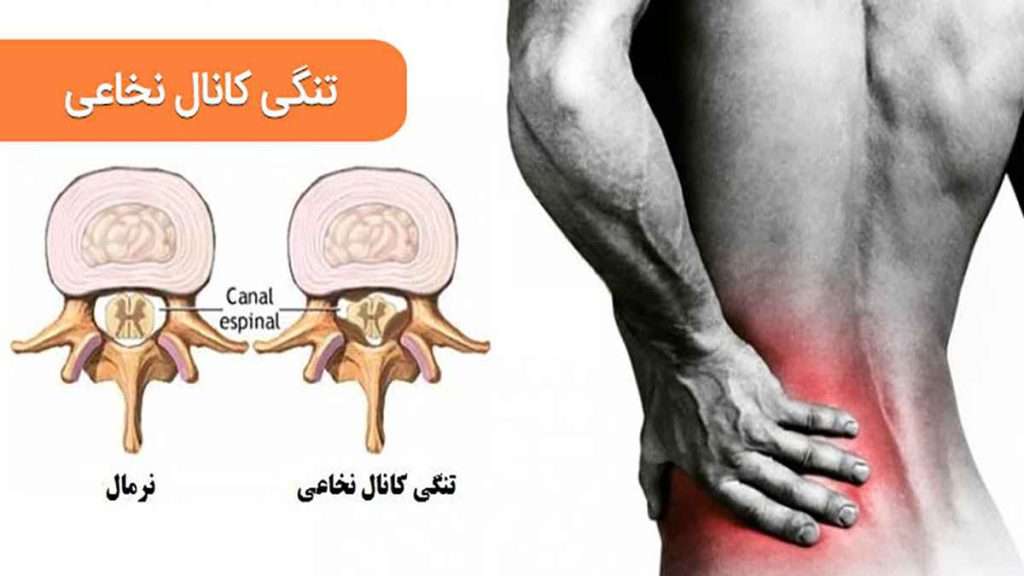 خطر تنگی کانال نخاعی
