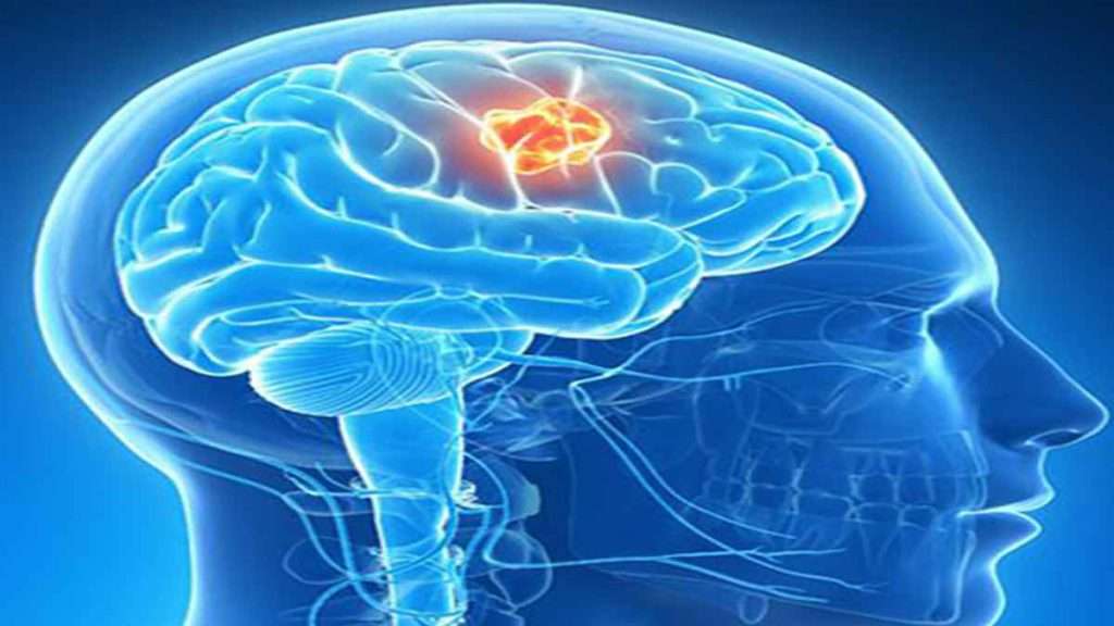 درمان بیماری مغز و اعصاب