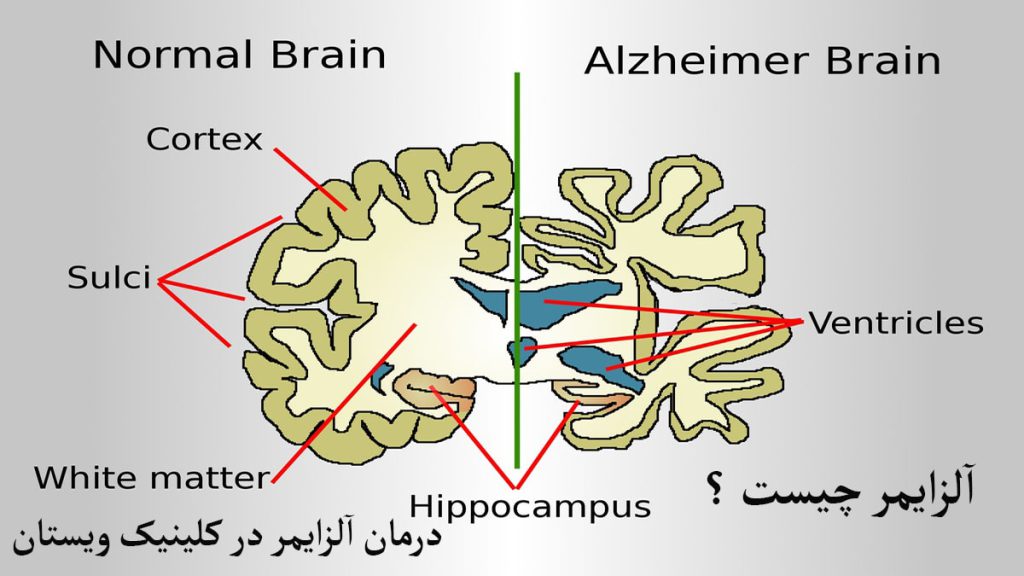بیماری آلزایمر بیماری آلزایمر و علائم آن نمایش داده می شود