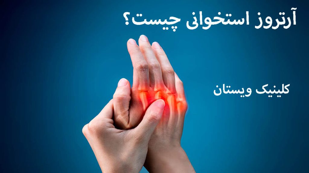 دست یک شخص که آرتروز دارد