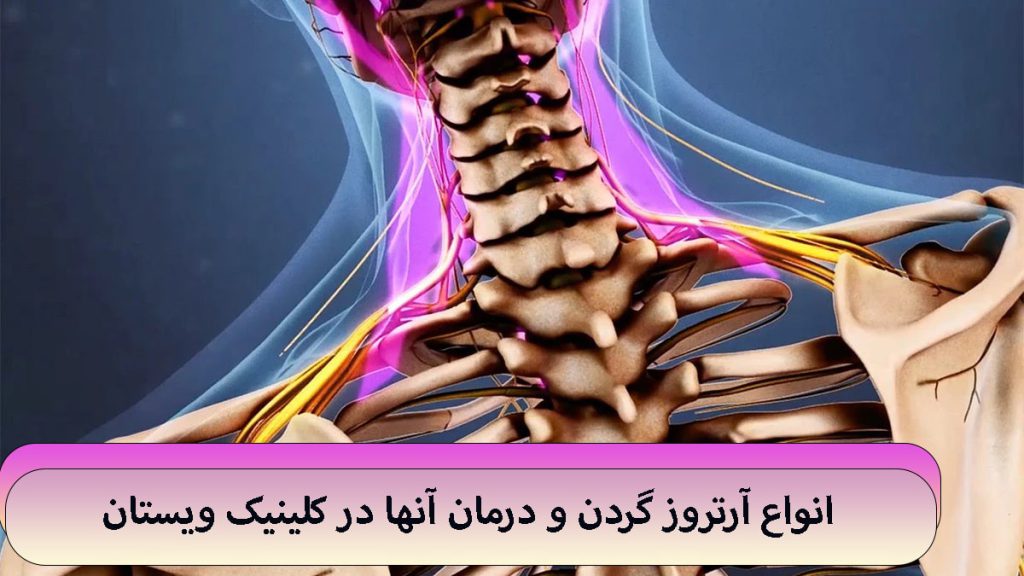 انواع آرتروز ستون فقرات و مهره های گردن شخص