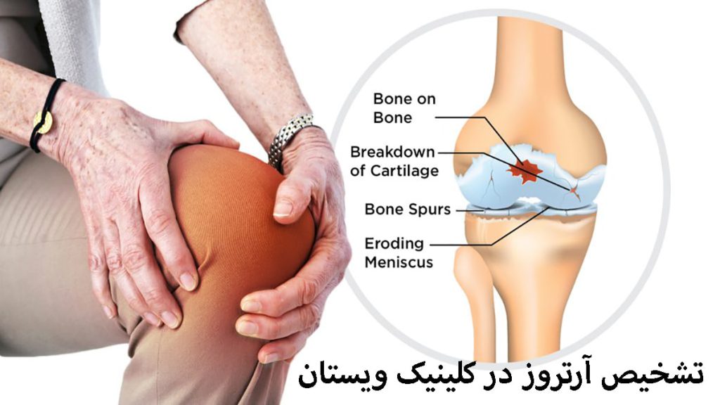 زانوی یک شخص که آرتروز دارد