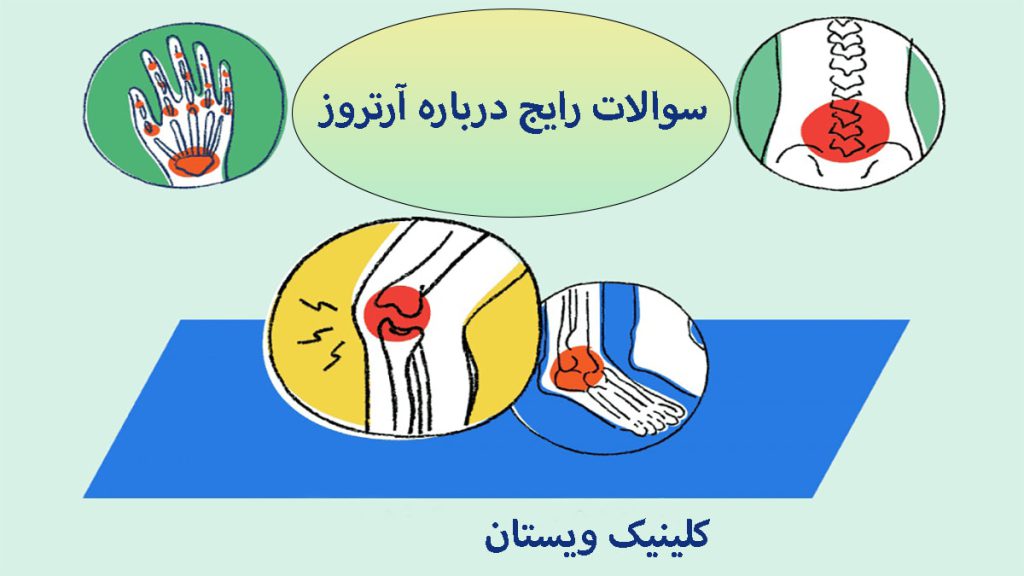 آرتروز انواع آرتروز در مفاصل مختلف بدن