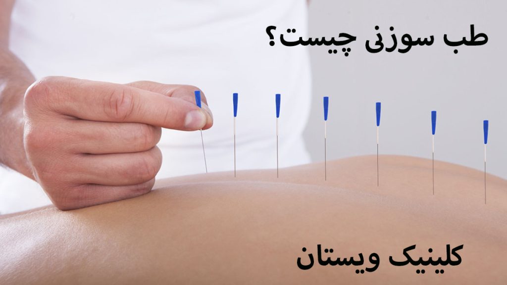 بدن یک شخص که چند سوزن برای طب سوزنی در آن فرو رفته است