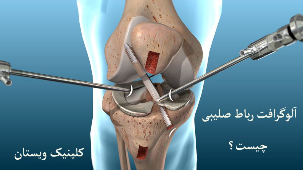 یک عمل جراحی بر روی زانو نشان داده می شود