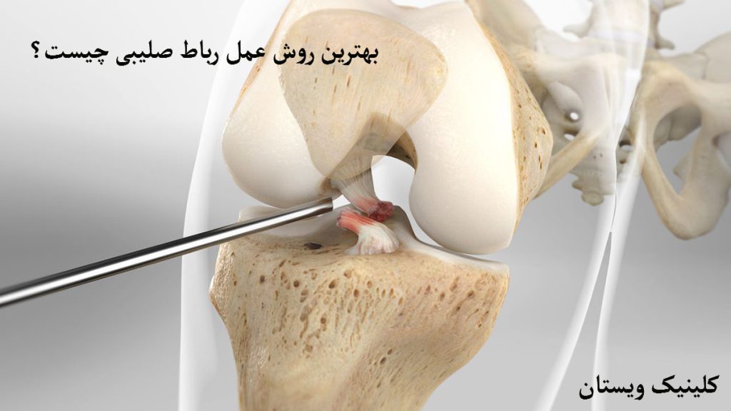 یک زانوی آسیب دیده-پارگی رباط صلیبی
