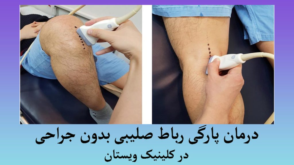 دو تصویر از درمان پارگی رباط صلیبی بدون جراحی