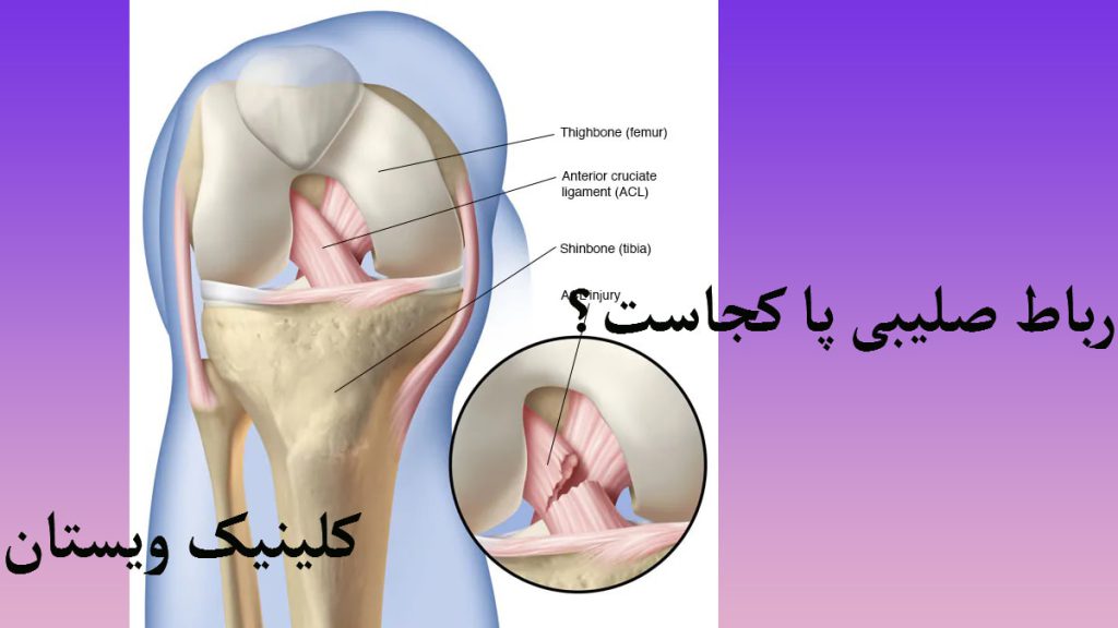 دو تصویر از رباط صلیبی پا که یکی زوم شده و واضح تر نشان داده می شود