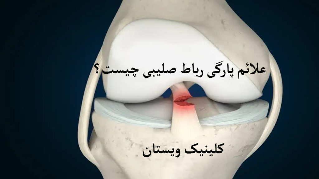 زانوی فرد که دچار آسیب پارگی رباط صلیبی شده است