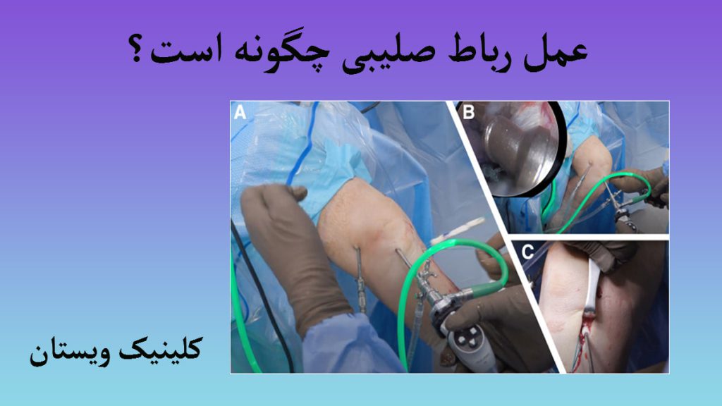 چند تصویر از عمل جراحی رباط صلیبی