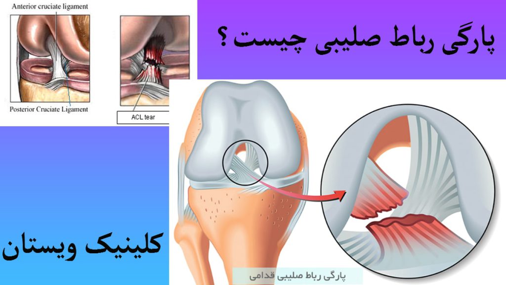 دو تصویر که بر روی هم قرار گرفته اند و در آنها پاره شدن رباط صلیبی زانو نشان داده می شود
