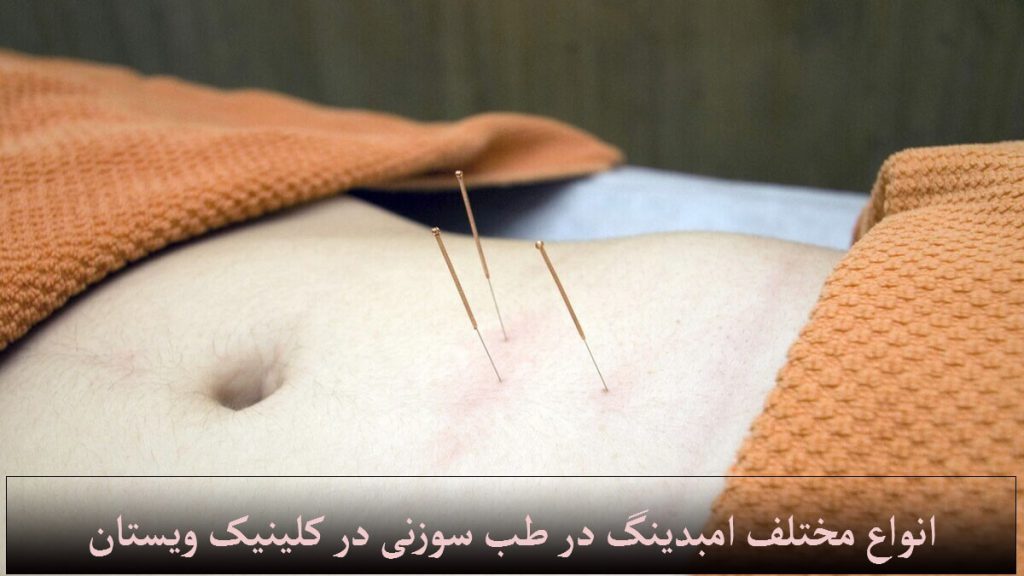 یک شخص که بر روی زمین دراز کشیده و در قسمت شکم طب سوزنی برای او انجام می شود