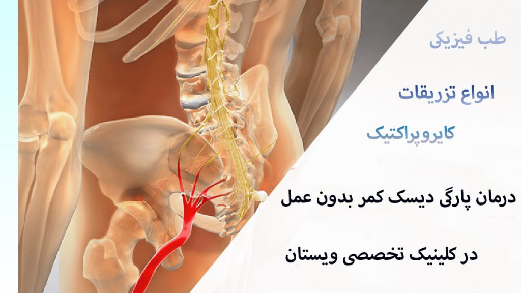 یک تصویر از آناتومی کمر و ستون فقرات به همراه یک نوشته درباره درمان پارگی دیسک کمر بدون جراحی