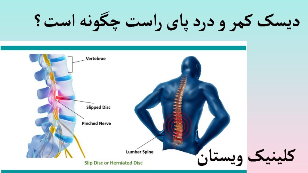 درد پای راست و کمر تصویری دیجیتالی از یک شخص که ستون فقرات او درد می کند