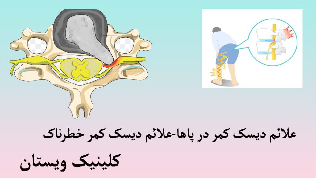 علائم دیسک کمر دو تصویر در یک قاب-یکی از شخصی که دچار دیسک کمر شده و دیگری از یک دیسک
