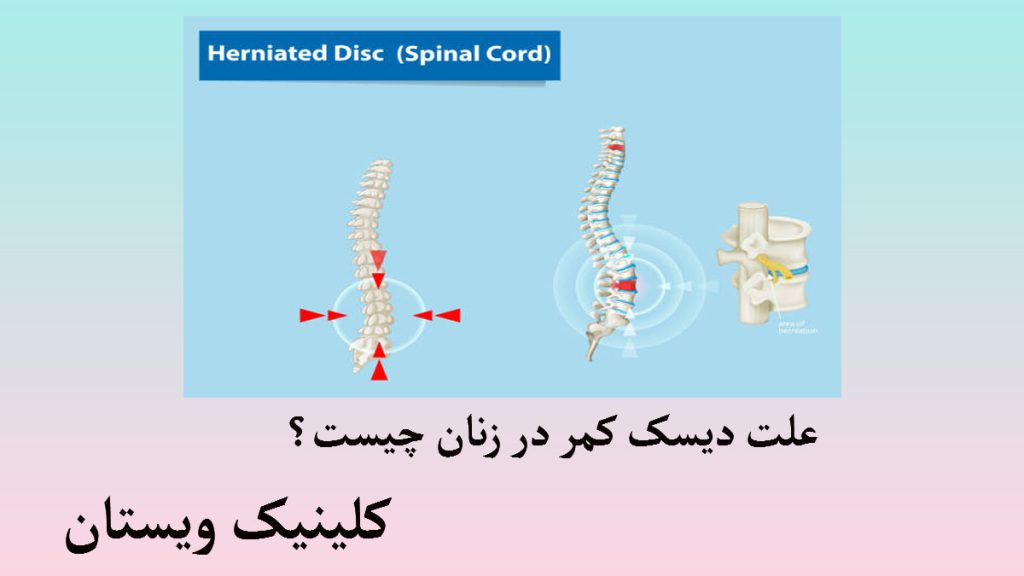 علت دیسک کمر سه تصویر از ستون فقرات در یک قاب