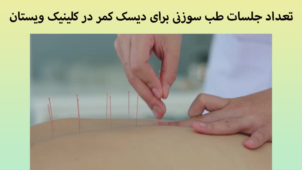 تعداد جلسات نقاط طب سوزنی چند سوزن طب سوزنی بر روی کمر یک بیمار