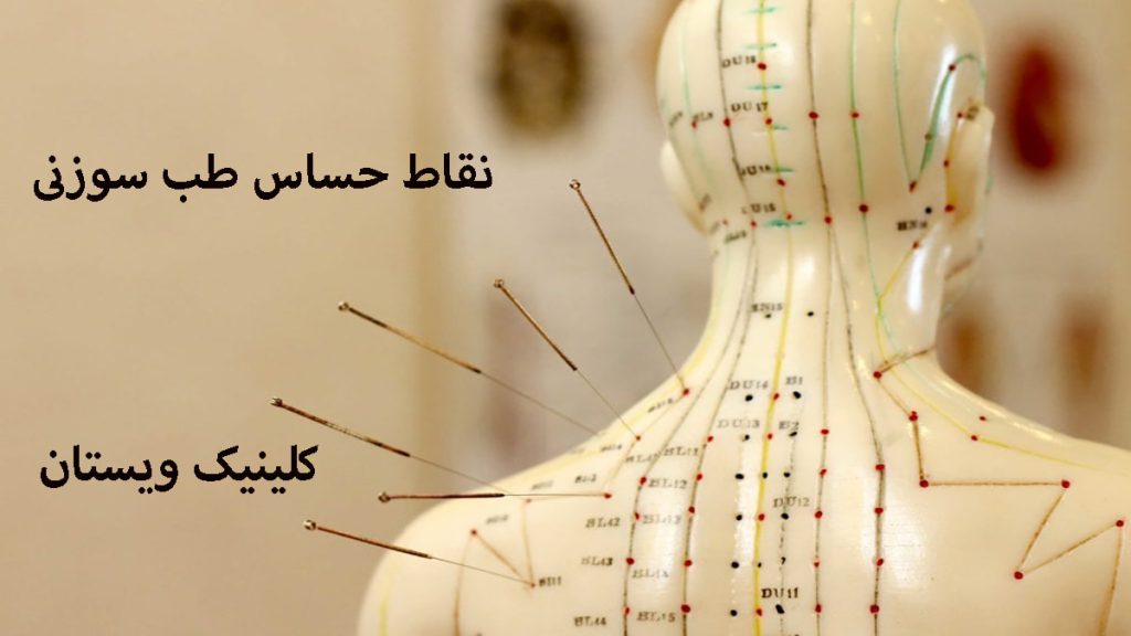 نقاط حساس طب سوزنی یک مولاژ بدن و نقاط طب سوزنی