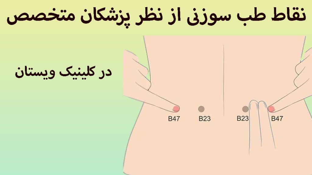 نقاط طب سوزنی چند نقطه مشخص شده برای طب سوزنی بر روی کمر