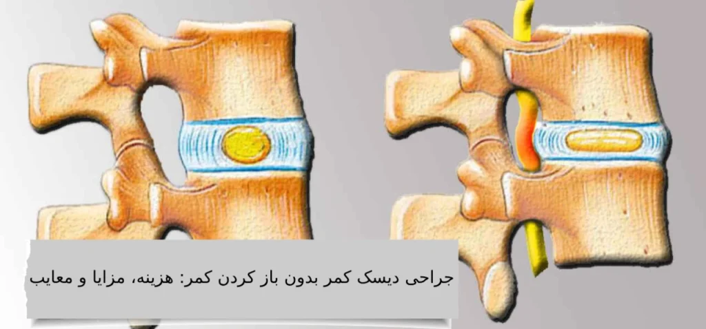 هزینه عمل میکروسکوپی دیسک کمر